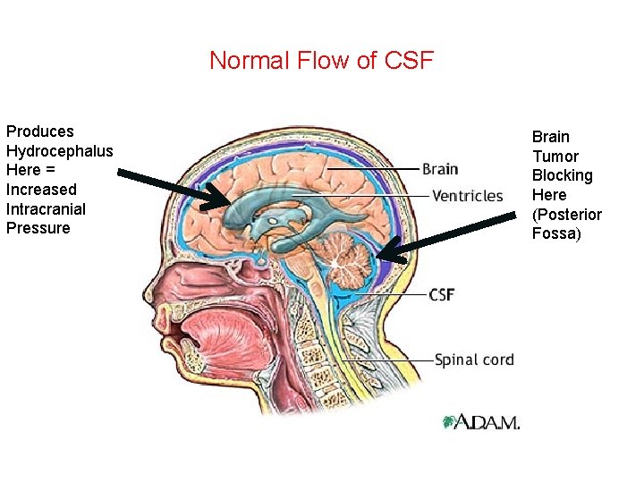 Normal Flow of CSF Produces Hydrocephalus Here = Increased Intracranial Pressure Brain Tumor Blocking Normal Flow of CSF Produces Hydrocephalus Here = Increased Intracranial Pressure Brain Tumor Blocking