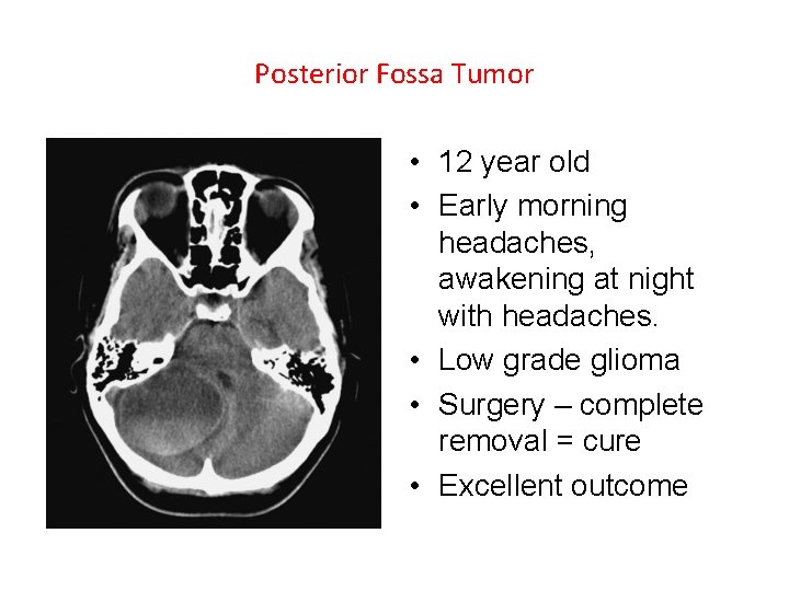Posterior Fossa Tumor • 12 year old • Early morning headaches, awakening at night Posterior Fossa Tumor • 12 year old • Early morning headaches, awakening at night