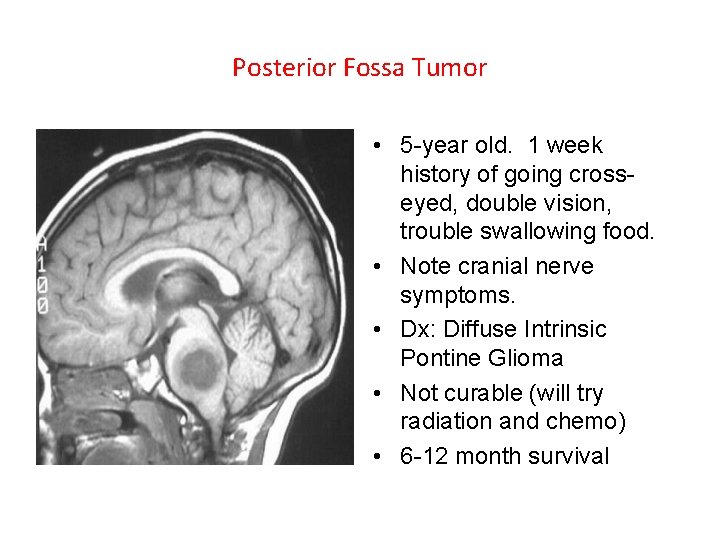 Posterior Fossa Tumor • 5 -year old. 1 week history of going crosseyed, double Posterior Fossa Tumor • 5 -year old. 1 week history of going crosseyed, double