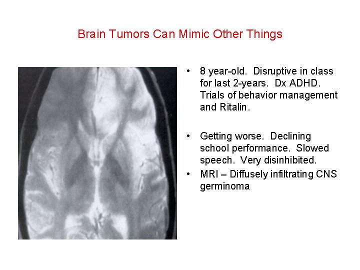 Brain Tumors Can Mimic Other Things • 8 year-old. Disruptive in class for last Brain Tumors Can Mimic Other Things • 8 year-old. Disruptive in class for last