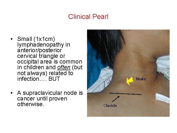 Clinical Pearl • Small (1 x 1 cm) lymphadenopathy in anterior/posterior cervical triangle or Clinical Pearl • Small (1 x 1 cm) lymphadenopathy in anterior/posterior cervical triangle or