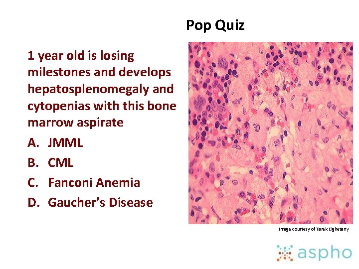 Pop Quiz 1 year old is losing milestones and develops hepatosplenomegaly and cytopenias with