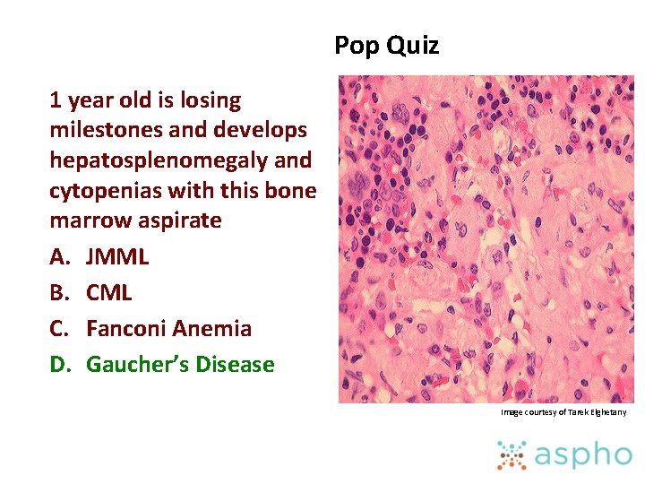 Pop Quiz 1 year old is losing milestones and develops hepatosplenomegaly and cytopenias with