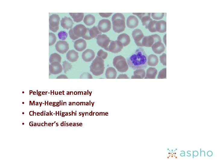  • • Pelger-Huet anomaly May-Hegglin anomaly Chediak-Higashi syndrome Gaucher’s disease 