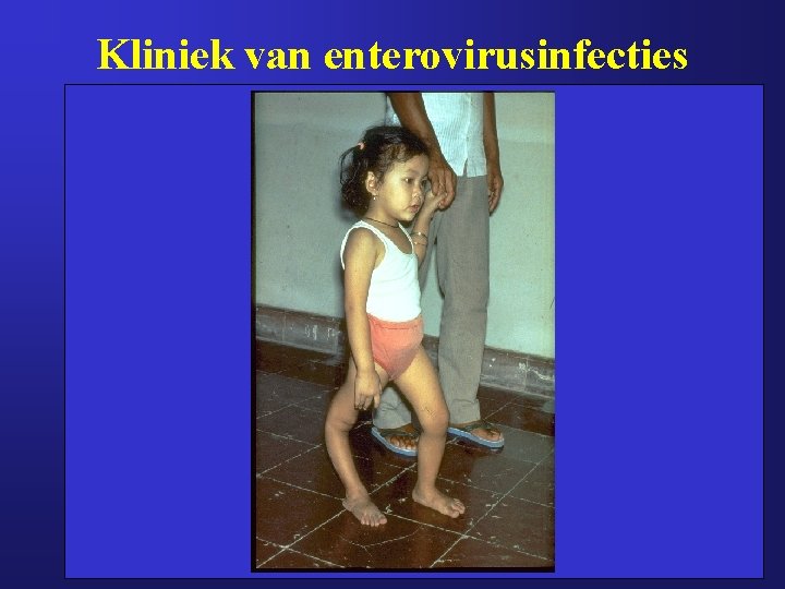 Kliniek van enterovirusinfecties 