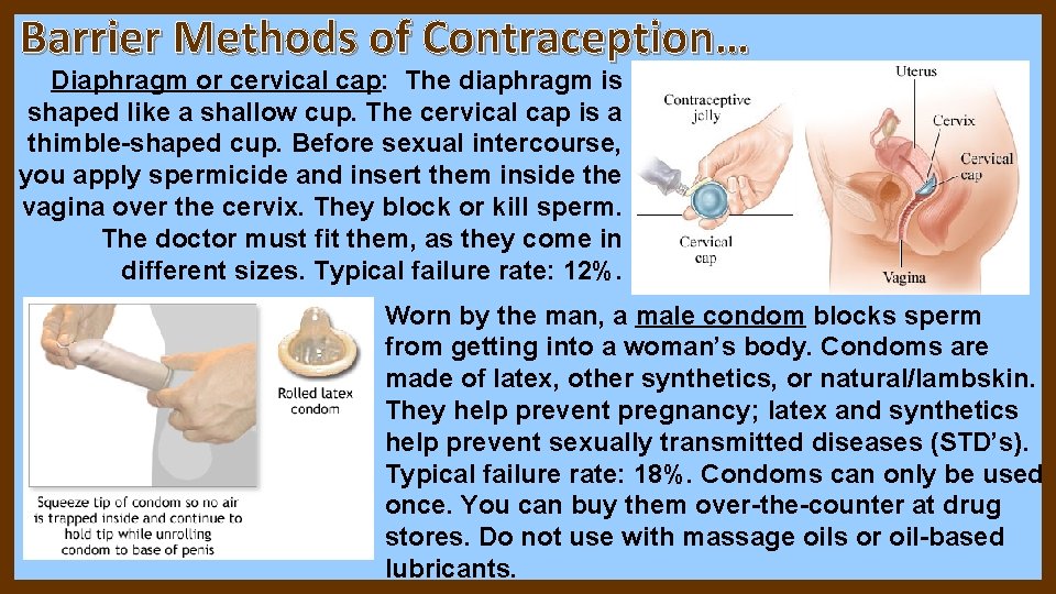 Barrier Methods of Contraception… Diaphragm or cervical cap: The diaphragm is shaped like a Barrier Methods of Contraception… Diaphragm or cervical cap: The diaphragm is shaped like a