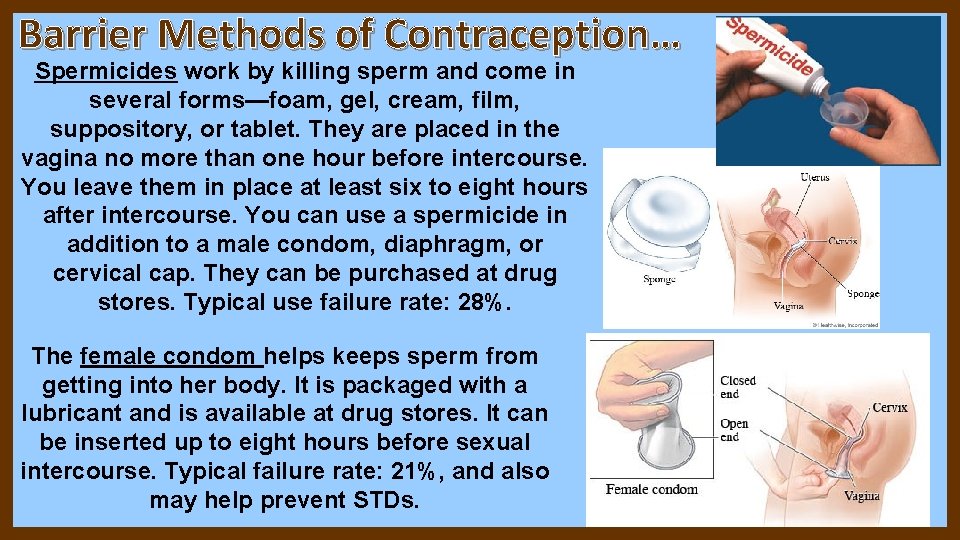 Barrier Methods of Contraception… Spermicides work by killing sperm and come in several forms—foam, Barrier Methods of Contraception… Spermicides work by killing sperm and come in several forms—foam,