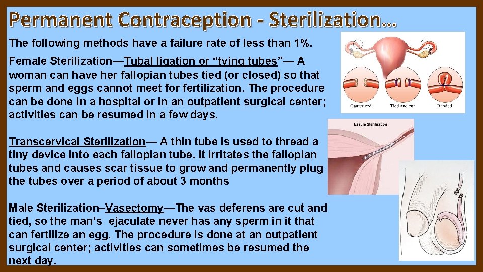 Permanent Contraception - Sterilization… The following methods have a failure rate of less than Permanent Contraception - Sterilization… The following methods have a failure rate of less than