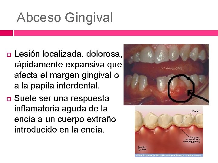 Abceso Gingival Lesión localizada, dolorosa, rápidamente expansiva que afecta el margen gingival o a