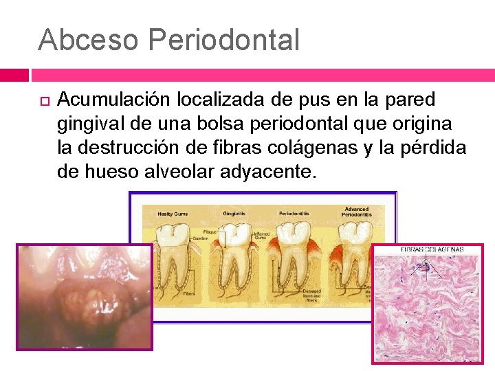 Abceso Periodontal Acumulación localizada de pus en la pared gingival de una bolsa periodontal