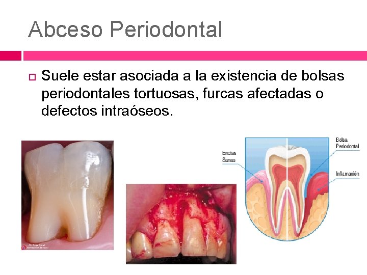 Abceso Periodontal Suele estar asociada a la existencia de bolsas periodontales tortuosas, furcas afectadas