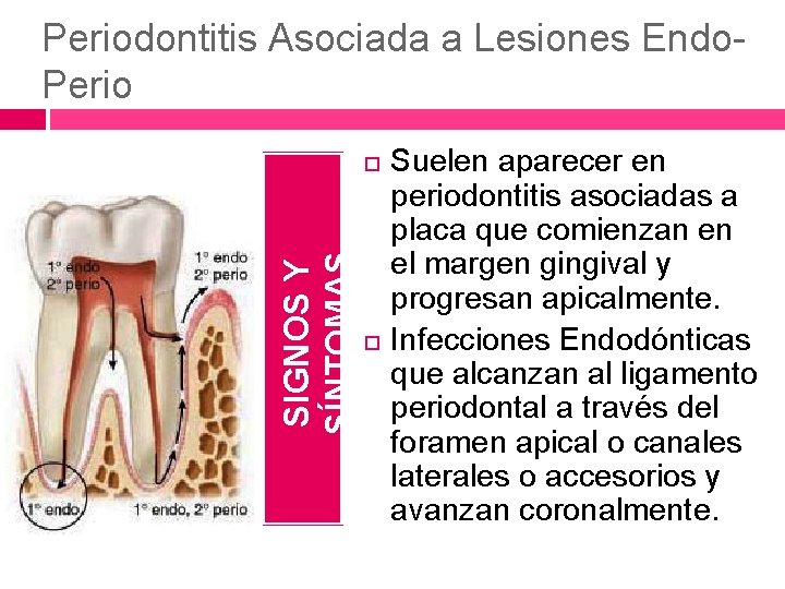 Periodontitis Asociada a Lesiones Endo. Perio SIGNOS Y SÍNTOMAS Suelen aparecer en periodontitis asociadas