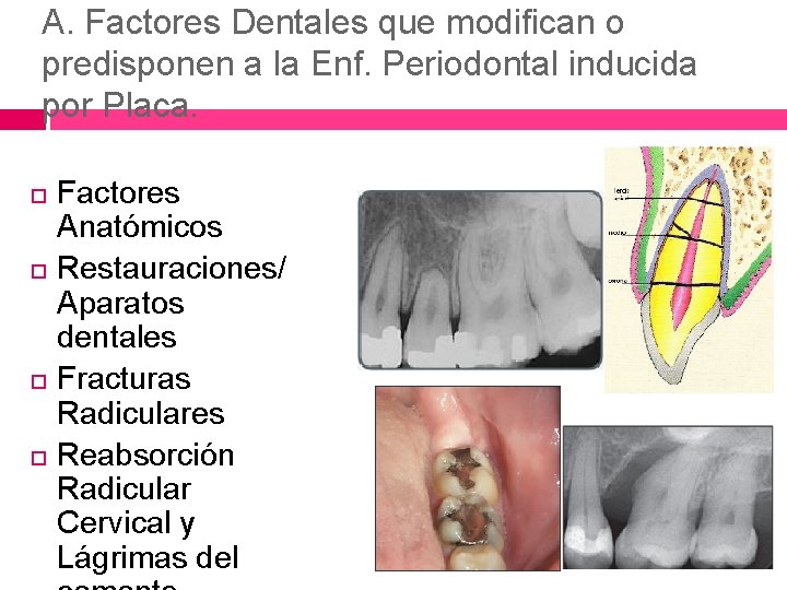 A. Factores Dentales que modifican o predisponen a la Enf. Periodontal inducida por Placa.