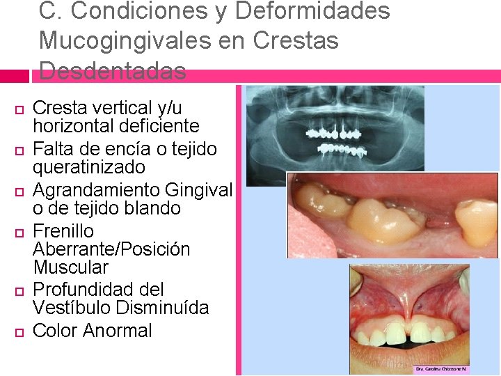 C. Condiciones y Deformidades Mucogingivales en Crestas Desdentadas Cresta vertical y/u horizontal deficiente Falta