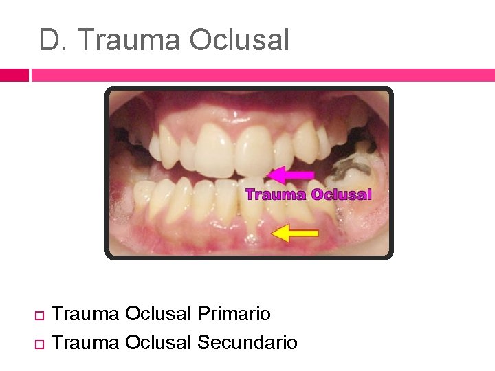 D. Trauma Oclusal Primario Trauma Oclusal Secundario 