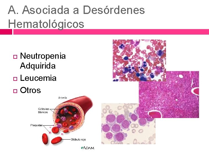 A. Asociada a Desórdenes Hematológicos Neutropenia Adquirida Leucemia Otros 