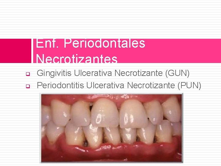 Enf. Periodontales Necrotizantes q q Gingivitis Ulcerativa Necrotizante (GUN) Periodontitis Ulcerativa Necrotizante (PUN) 