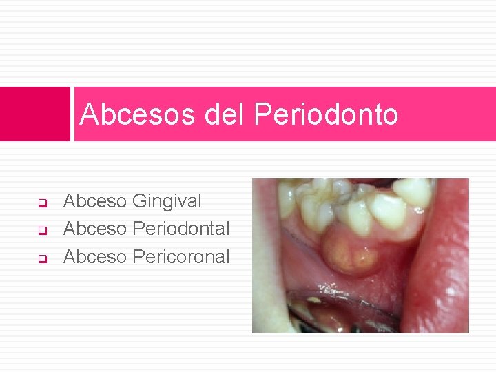 Abcesos del Periodonto q q q Abceso Gingival Abceso Periodontal Abceso Pericoronal 