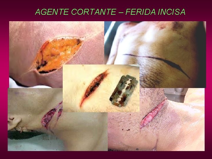 AGENTE CORTANTE – FERIDA INCISA AGENTE CORTANTE – FERIDA INCISA