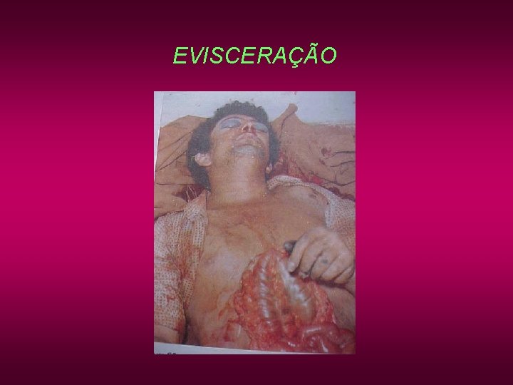 EVISCERAÇÃO EVISCERAÇÃO