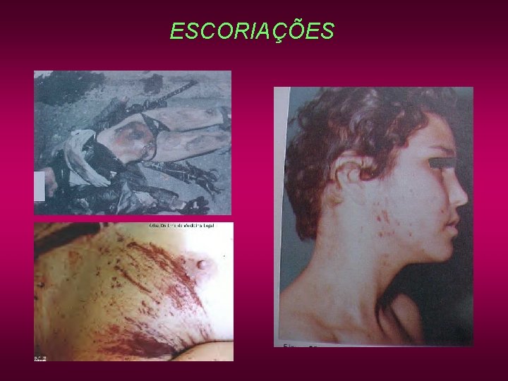 ESCORIAÇÕES ESCORIAÇÕES