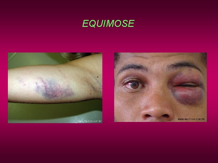EQUIMOSE EQUIMOSE
