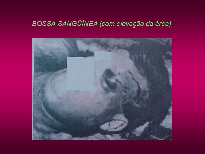 BOSSA SANGÜÍNEA (com elevação da área) BOSSA SANGÜÍNEA (com elevação da área)