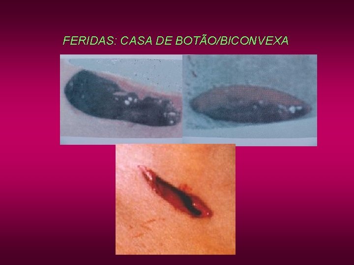 FERIDAS: CASA DE BOTÃO/BICONVEXA FERIDAS: CASA DE BOTÃO/BICONVEXA