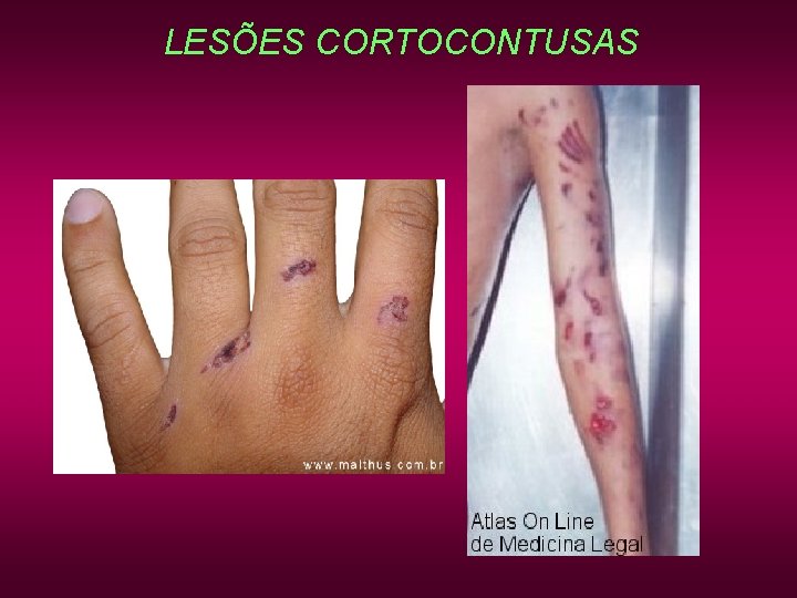 LESÕES CORTOCONTUSAS LESÕES CORTOCONTUSAS