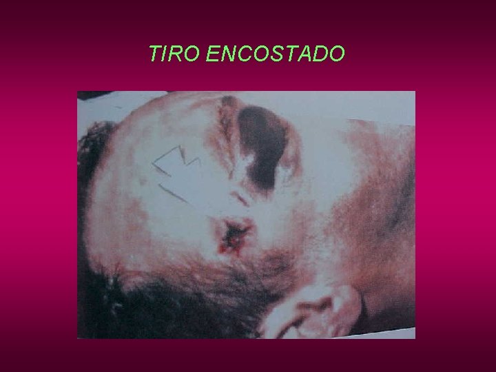 TIRO ENCOSTADO TIRO ENCOSTADO
