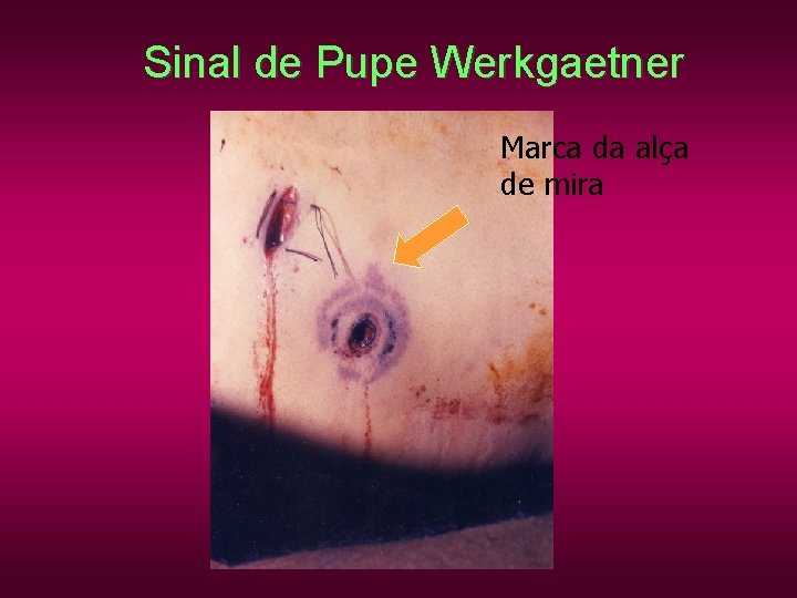 Sinal de Pupe Werkgaetner Marca da alça de mira Sinal de Pupe Werkgaetner Marca da alça de mira