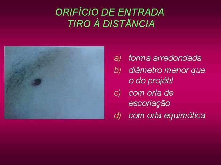 ORIFÍCIO DE ENTRADA TIRO À DIST NCIA a) forma arredondada b) diâmetro menor que ORIFÍCIO DE ENTRADA TIRO À DIST NCIA a) forma arredondada b) diâmetro menor que