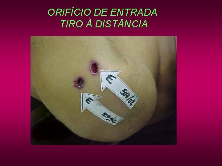 ORIFÍCIO DE ENTRADA TIRO À DIST NCIA ORIFÍCIO DE ENTRADA TIRO À DIST NCIA