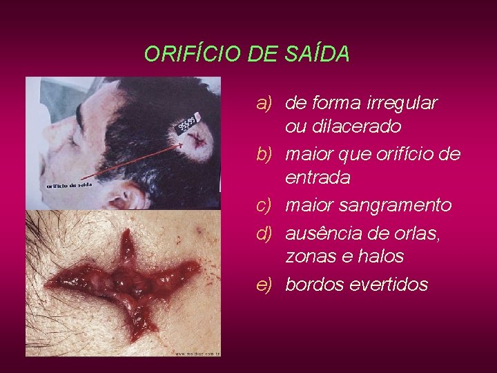 ORIFÍCIO DE SAÍDA a) de forma irregular ou dilacerado b) maior que orifício de ORIFÍCIO DE SAÍDA a) de forma irregular ou dilacerado b) maior que orifício de