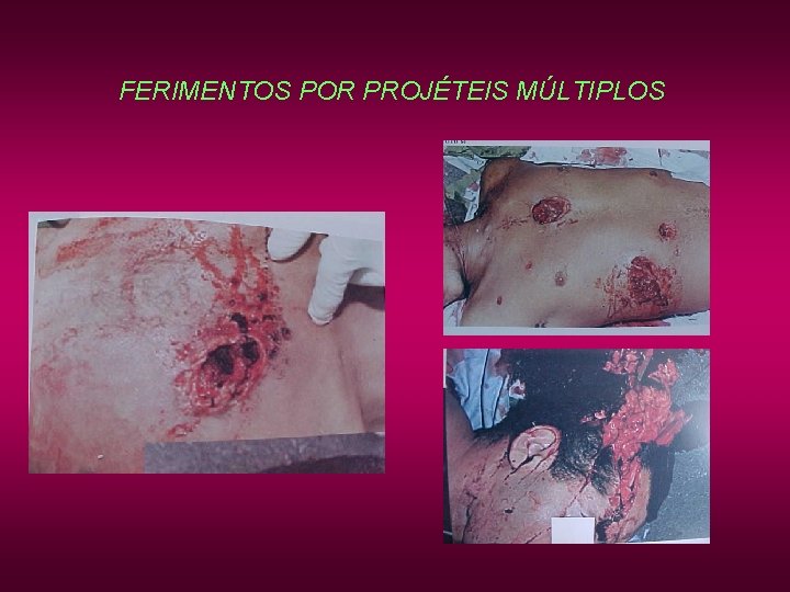 FERIMENTOS POR PROJÉTEIS MÚLTIPLOS FERIMENTOS POR PROJÉTEIS MÚLTIPLOS