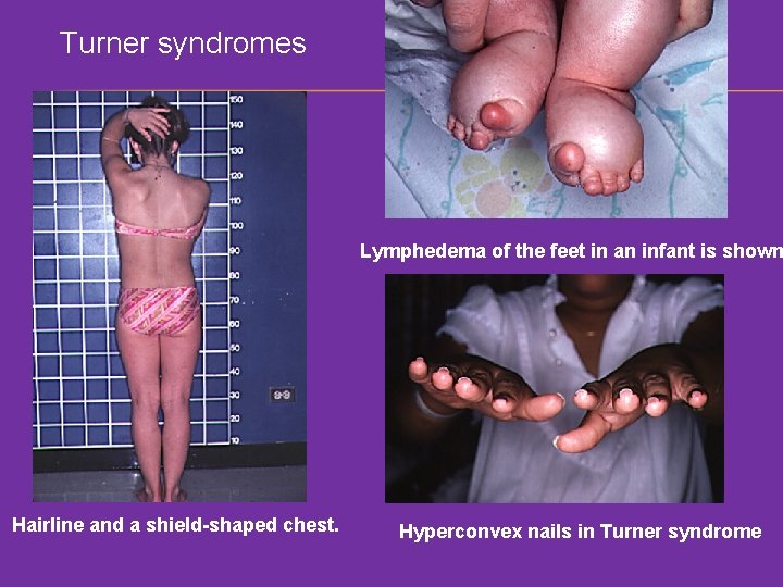 Turner syndromes Lymphedema of the feet in an infant is shown Hairline and a