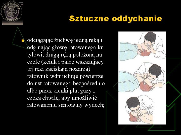 Sztuczne oddychanie n odciągając żuchwę jedną ręką i odginając głowę ratowanego ku tyłowi, drugą