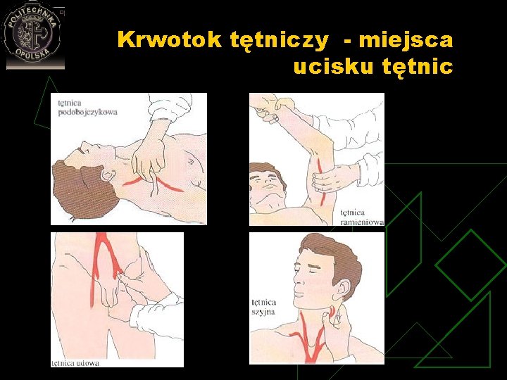 Krwotok tętniczy - miejsca ucisku tętnic 