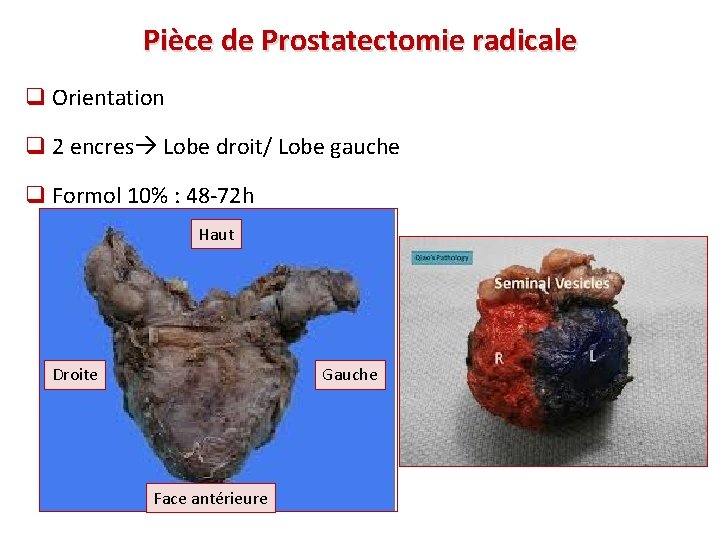 Pièce de Prostatectomie radicale q Orientation q 2 encres Lobe droit/ Lobe gauche q