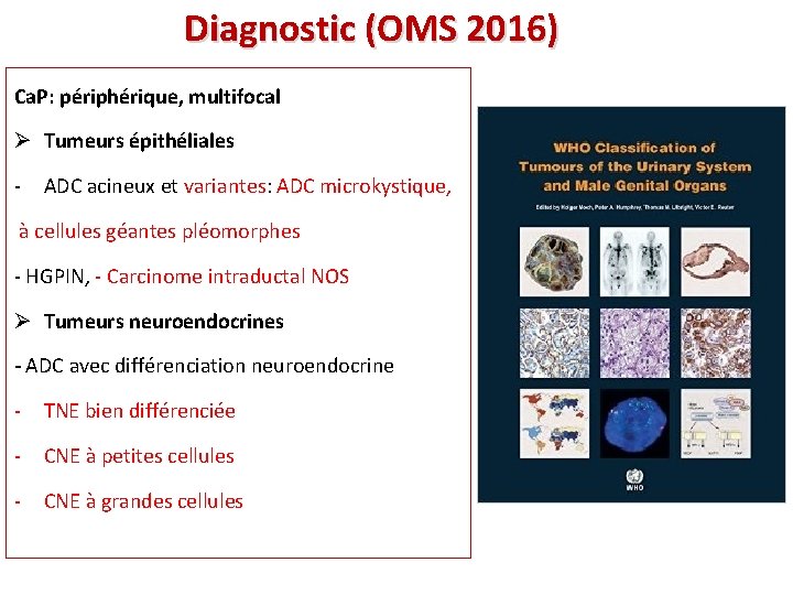 Diagnostic (OMS 2016) Ca. P: périphérique, multifocal Ø Tumeurs épithéliales - ADC acineux et