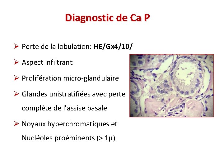 Diagnostic de Ca P Ø Perte de la lobulation: HE/Gx 4/10/ Ø Aspect infiltrant