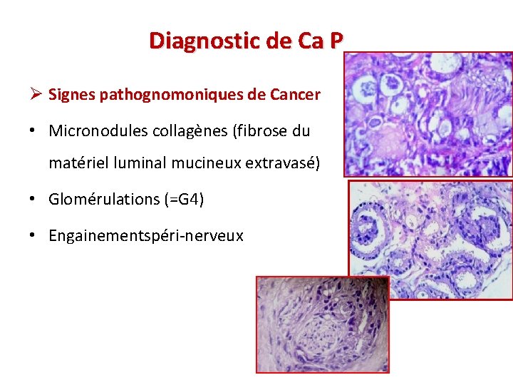 Diagnostic de Ca P Ø Signes pathognomoniques de Cancer • Micronodules collagènes (fibrose du