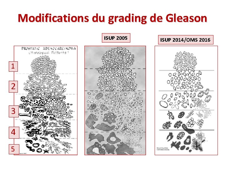 Modifications du grading de Gleason ISUP 2005 1 2 3 4 5 ISUP 2014/OMS