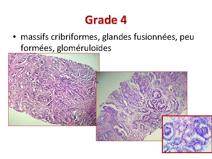 Grade 4 • massifs cribriformes, glandes fusionnées, peu formées, gloméruloïdes 