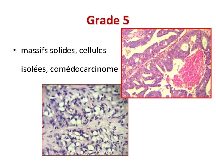 Grade 5 • massifs solides, cellules isolées, comédocarcinome 