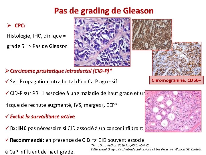 Pas de grading de Gleason Ø CPC: Histologie, IHC, clinique ≠ grade 5 =>