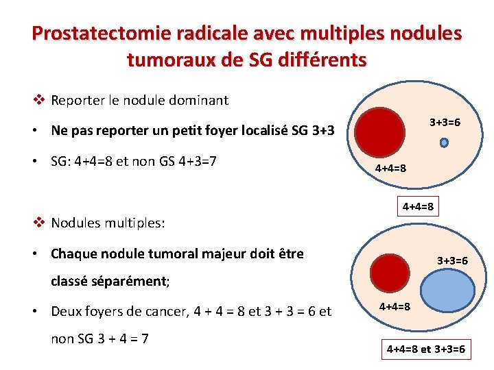 Prostatectomie radicale avec multiples nodules tumoraux de SG différents v Reporter le nodule dominant