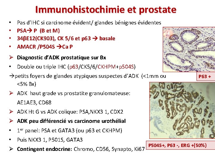 Immunohistochimie et prostate • • Pas d’IHC si carcinome évident/ glandes bénignes évidentes PSA