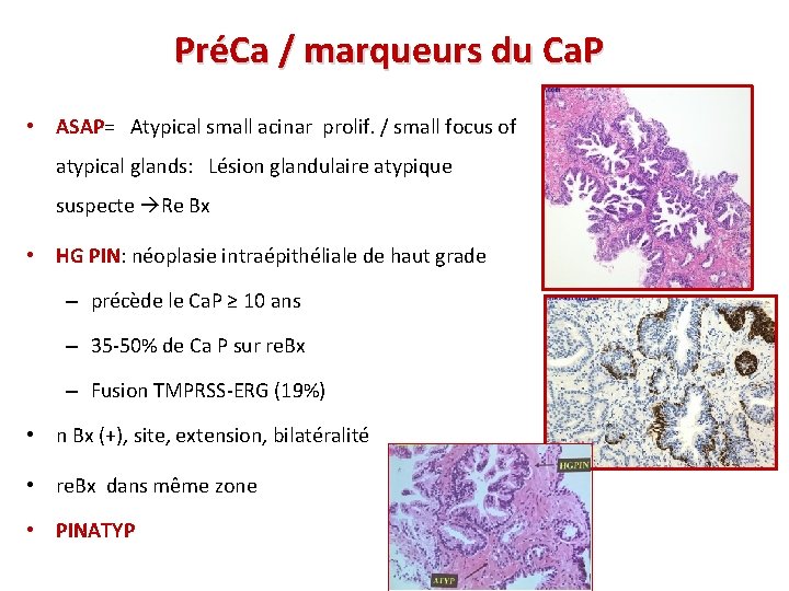 PréCa / marqueurs du Ca. P • ASAP= Atypical small acinar prolif. / small