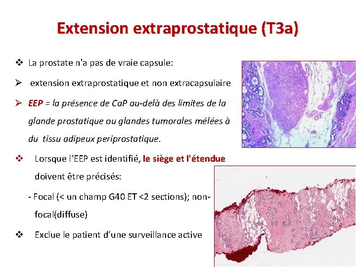 Extension extraprostatique (T 3 a) v La prostate n'a pas de vraie capsule: Ø